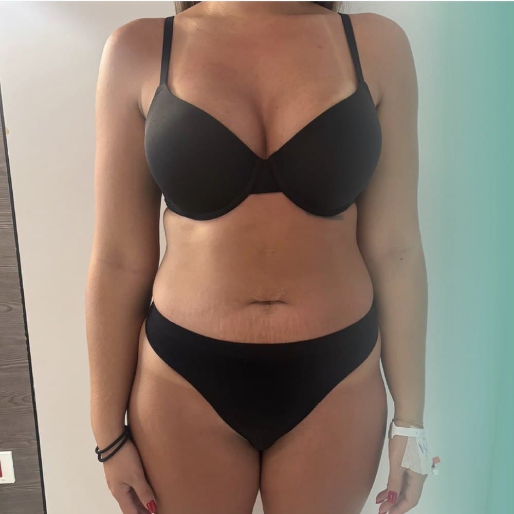 360 LİPO & BBL öncesi