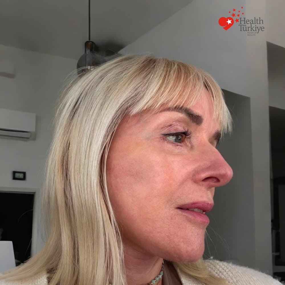 YÜZ & BOYUN GERME sonrası