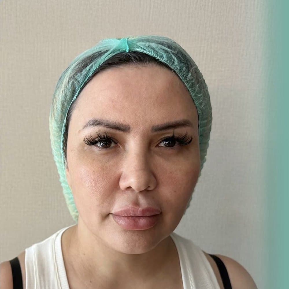 YÜZ & BOYUN GERME öncesi