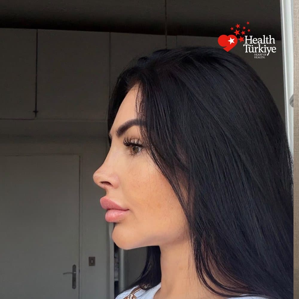 BURUN ESTETİĞİ sonrası