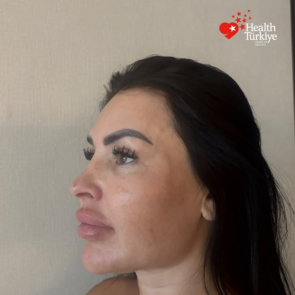 BURUN ESTETİĞİ öncesi