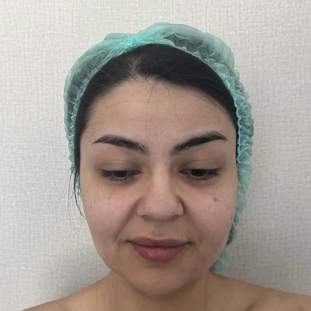 İZSİZ YÜZ GERME öncesi